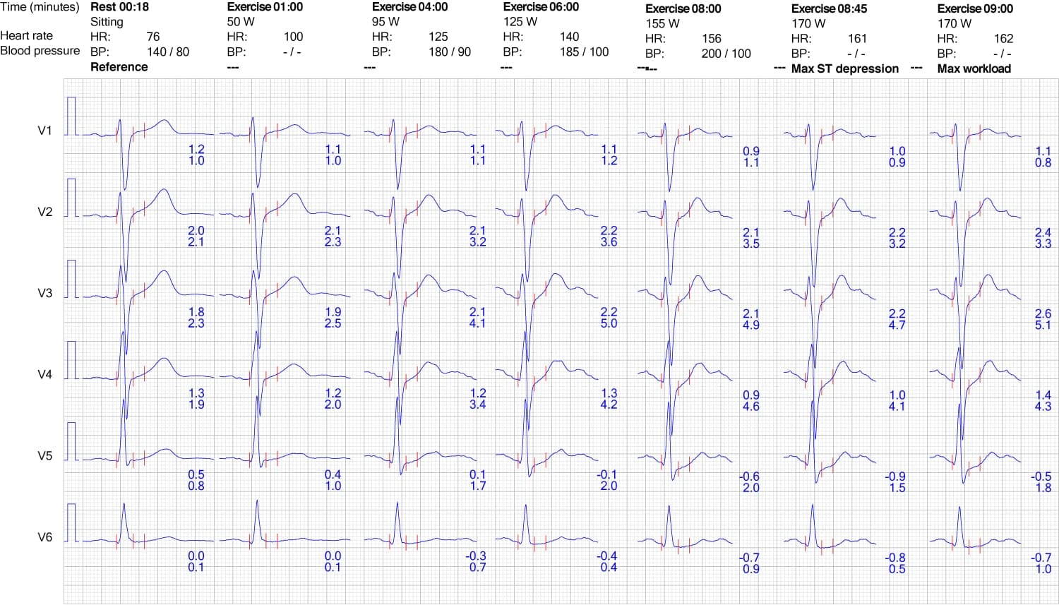 Illustration ur kursen EKG-Test 9
