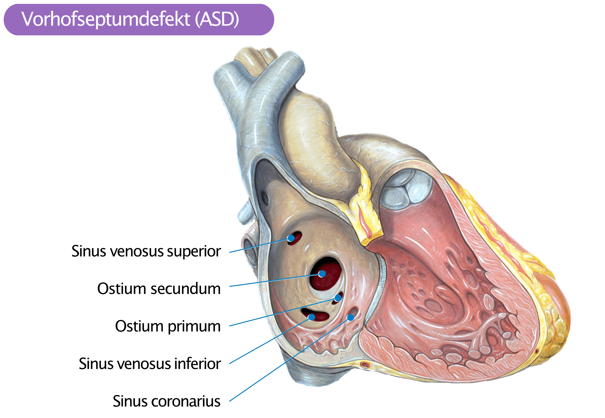 Angeborene Herzfehler EMAH Vorhofseptumdefekt ASD Atrial Septal Defect