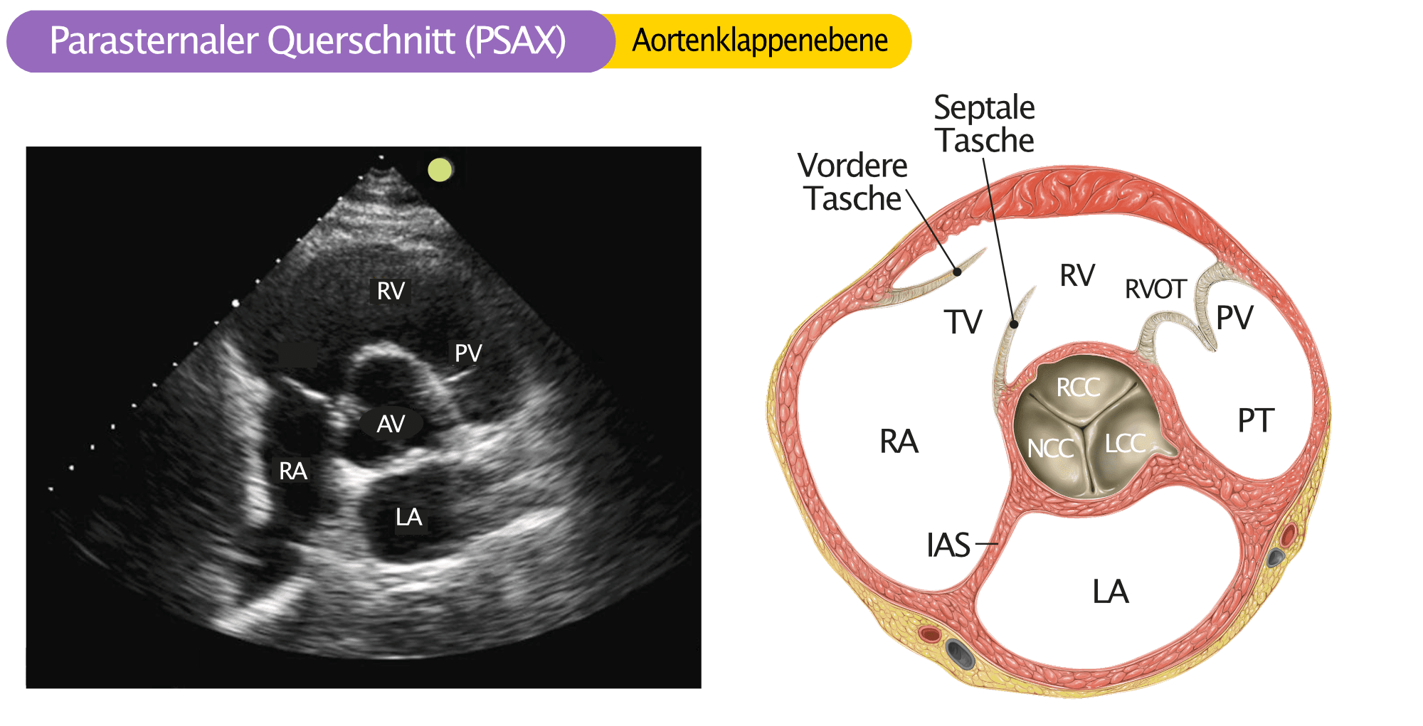 Aortenklappenstenose Ekokardiographie Kurzachsenschnitt Aortenklappe