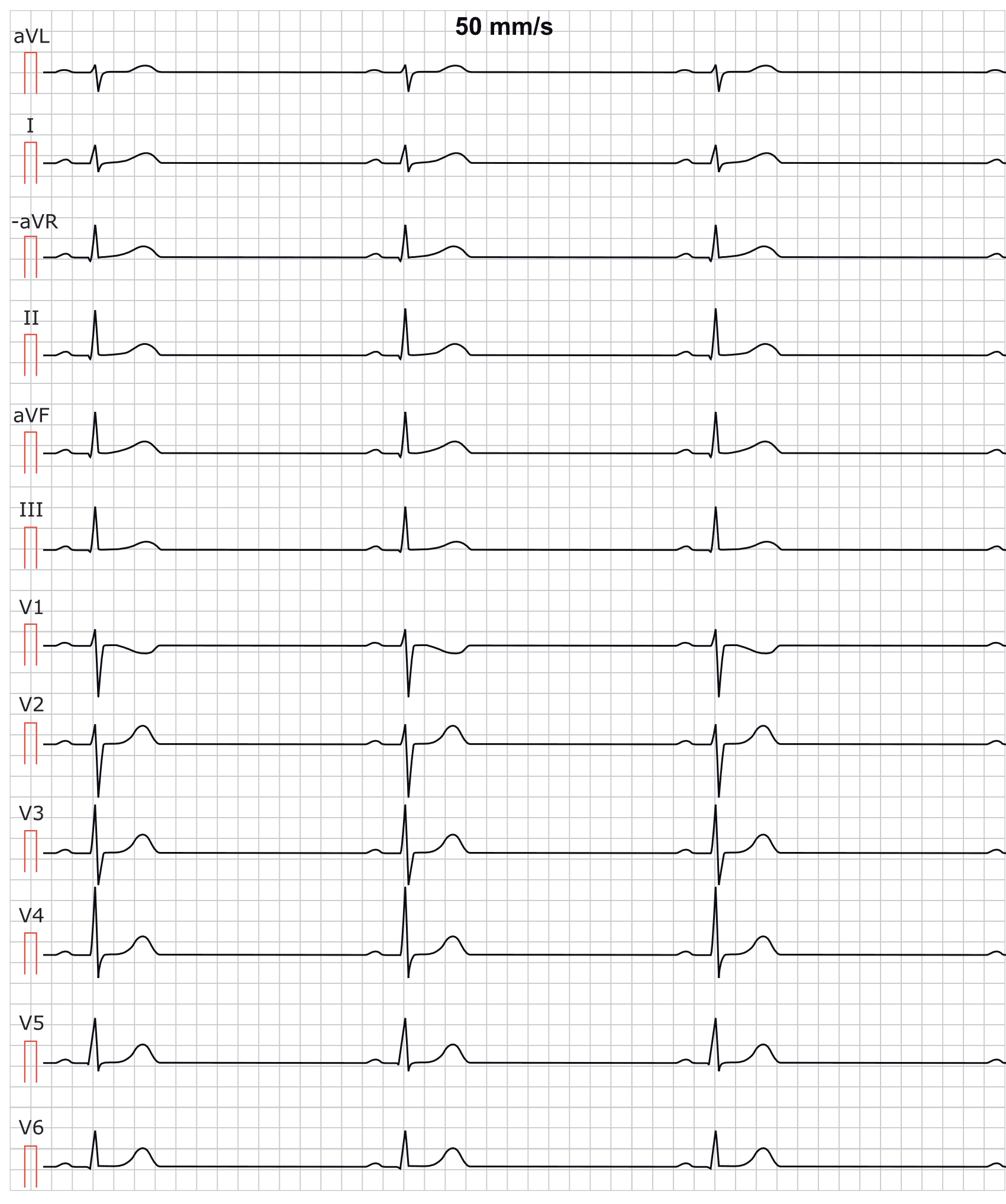 Illustration ur kursen EKG-Test 4