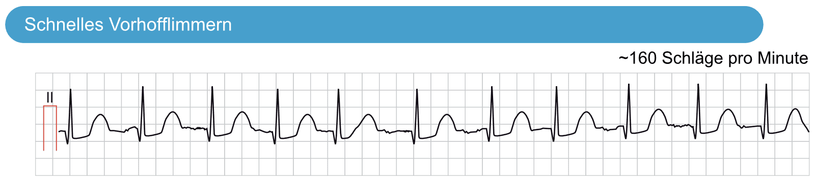 Illustration ur kursen Supraventrikuläre Arrhythmien