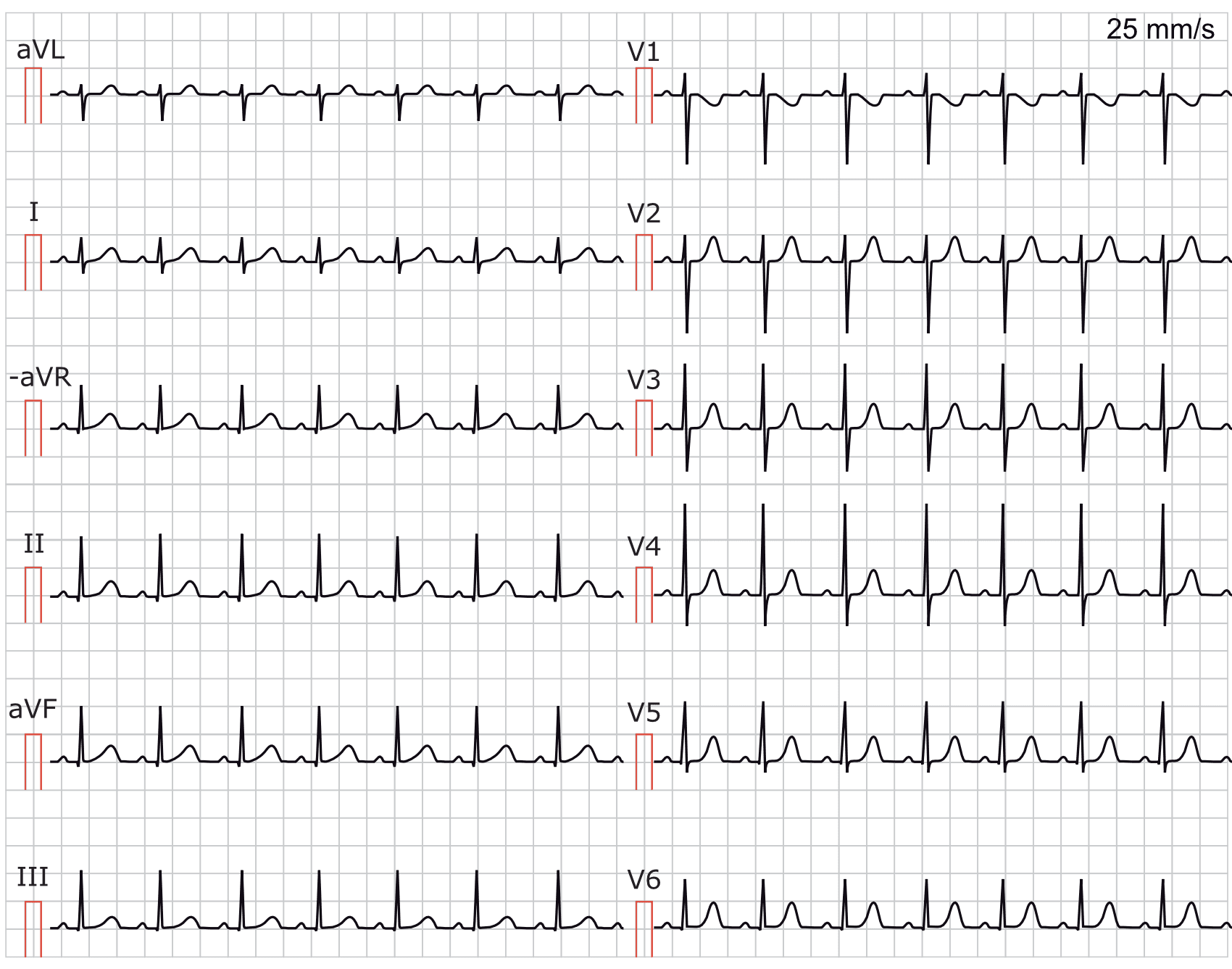 Illustration ur kursen EKG-Test 5