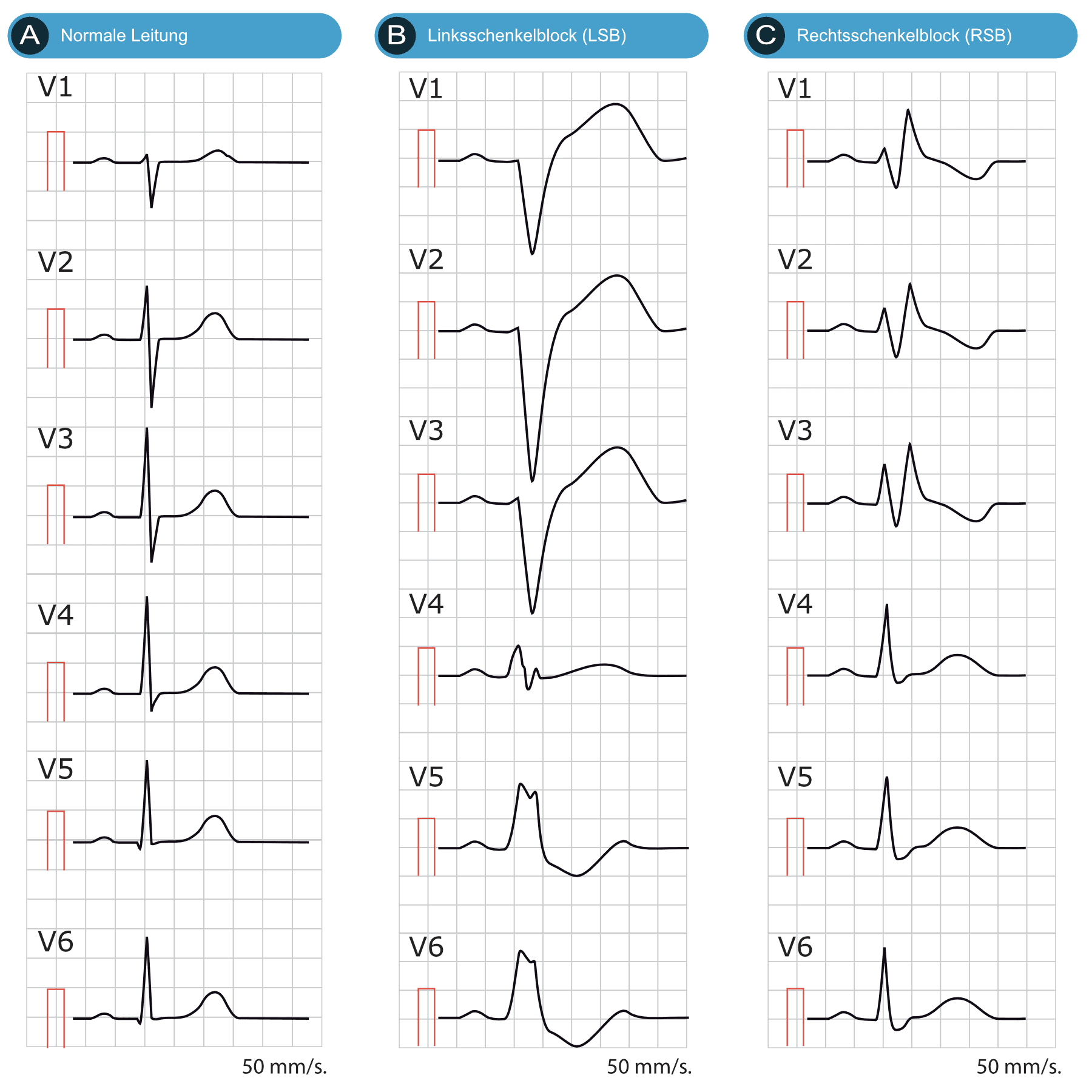 Illustration ur kursen EKG-Test 3