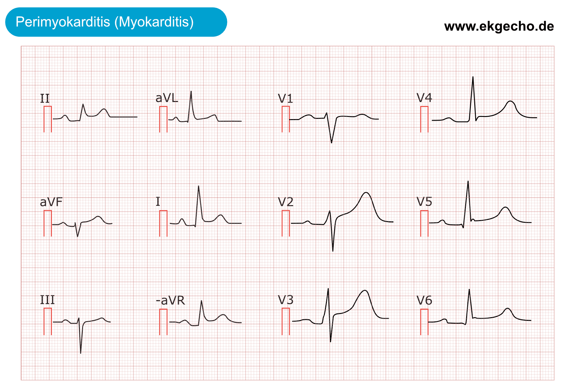 Illustration ur kursen EKG Übungstest 1