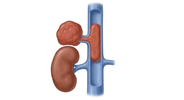 Gezeichnete Frontalansicht eines knotigen Tumors oberhalb des oberen Pols der rechten Niere, der über eine kurze Nebennierenvene mit der Vena cava inferior verbunden ist. Die Vorderwand des Gefäßes ist entfernt, sodass ein solider Tumorzapfen im Lumen sichtbar ist, mit offenem Gefäßlumen oberhalb und unterhalb des Zapfens.