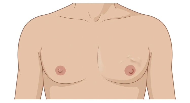 Frontalansicht des Brustkorbs eines Mannes. Die rechte Seite ist unauffällig; auf der linken Seite finden sich eine unregelmäßige Hauteinziehung oberhalb und lateral der Areola sowie eine eingezogene Mamille.