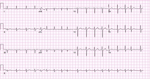 Figure 5. Example of 12-lead ECG with atrial fibrillation. Paperspeed: 25 mm/s.