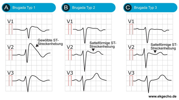 Abbildung 10. Brugada-Syndrom Typ 1, Typ 2 und Typ 3.