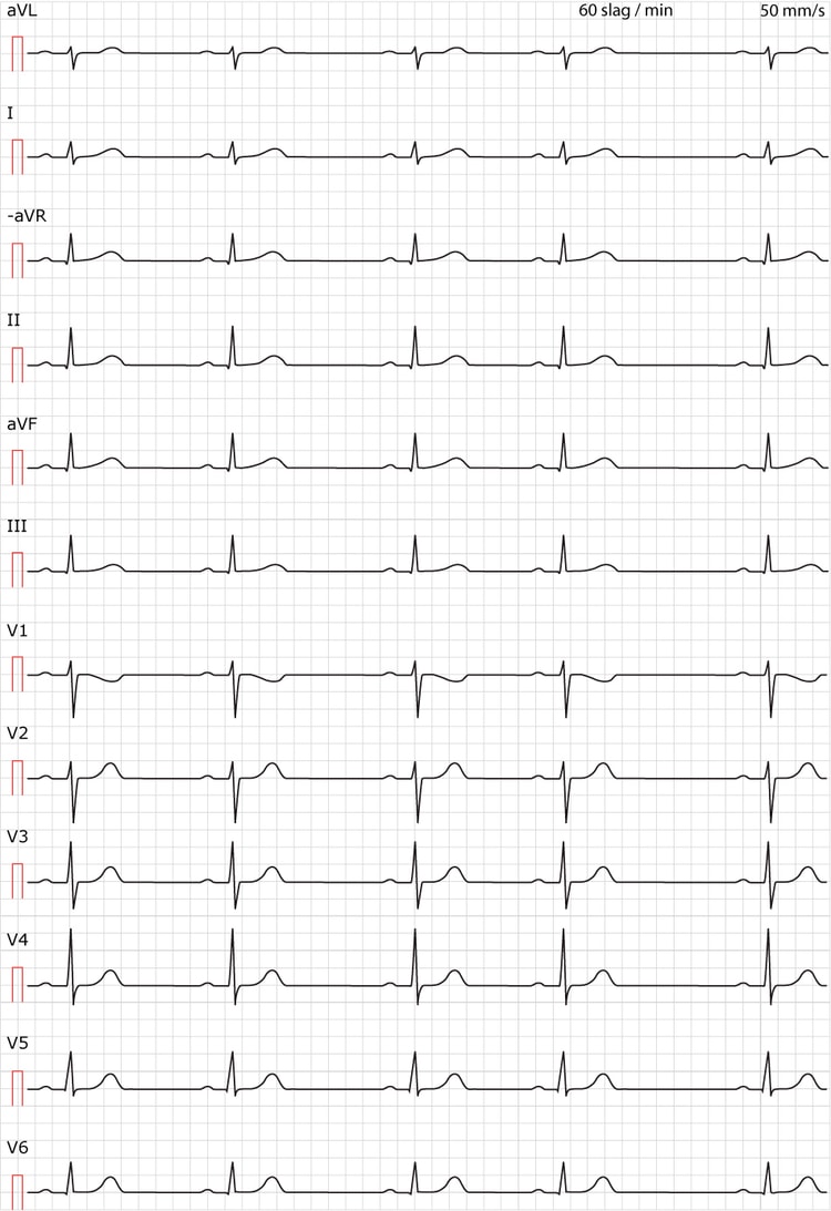 EKG test