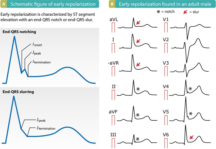 Abbildung 4. Muster der frühen Repolarisation im EKG. Zu beachten sind die Kerbungen und Schleuderungen am Ende des QRS-Komplexes sowie die ST-Hebungen.