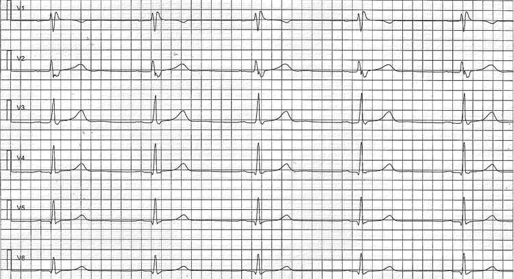 Figure 2. Chest (precordial) leads showing early repolarization pattern. This patients brother died from sudden cardiac arrest at the age of 29. Note the incomplete right bundle branch block (RBBB).