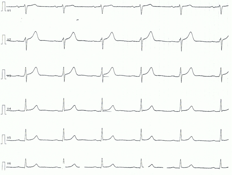 Figure 3. Chest leads of patient with acute pericarditis. Note the ST segment elevations, concave ST segments.