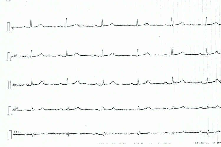 Figure 4. Limb leads of patient with acute pericarditis. Note the very discrete, but generalized, ST segment elevations, concave ST segments.