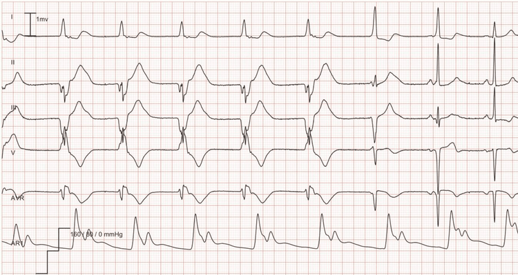 ECG Example: Idioventricular rhythm (accelerated ventricular rhythm) – Accelerated ventricular rhythm at a rate of 56 for the first 5 beats followed by 2 fusion beats; the last 2 beats are normal sinus rhythm.