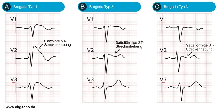 Abbildung 1. Brugada-Syndrom Typ 1, Typ 2, Typ 3.