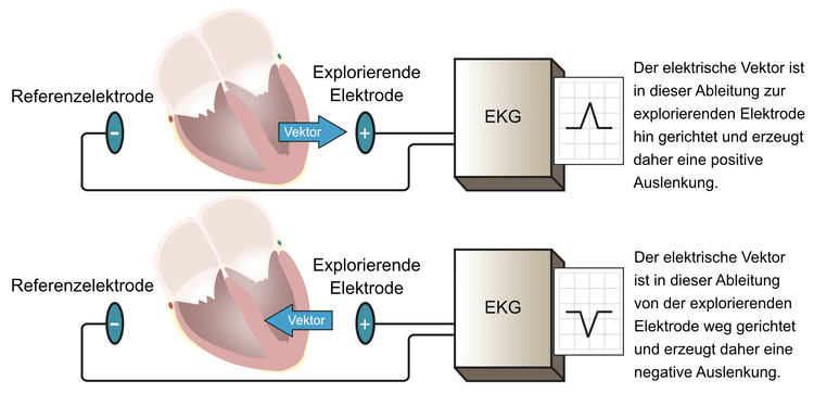 Abbildung 6. Eine EKG-Ableitung zeigt eine EKG-Kurve (Diagramm). Mindestens zwei Elektroden sind notwendig, um ein EKG-Ableitung zu erhalten. Eine der Elektroden dient als Referenzelektrode und die andere als explorierende Elektrode. Der Elektrokardiograph vergleicht die in den Elektroden abgeleiteten elektrischen Potentiale. Wenn sich ein Vektor in Richtung der Explorationselektrode und von der Referenzelektrode weg bewegt, entsteht eine positive Welle.