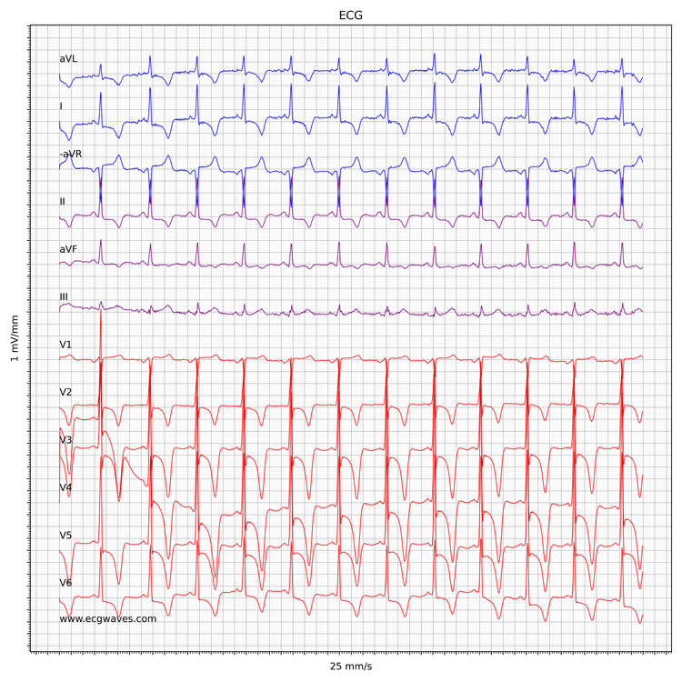 ECG in hypertrophic obstructive cardiomyopathy (HCM, HOCM)