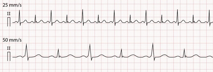 Figure 6. ECG displaying each and every beat conducted through an accessory pathway, which results in variations in QRS-amplitude.