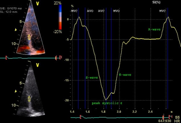 Figure 5. Examination of strain (longitudinal strain) with tissue Doppler. Septal strain is examined. Y-axis depicts strain (% deformation) and X-axis depicts time. Source | License.