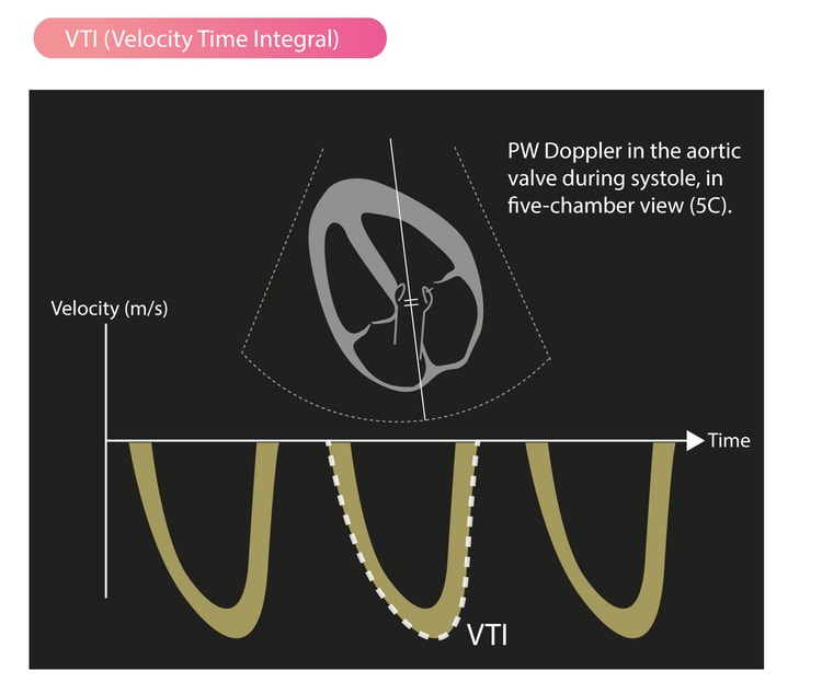 Abbildung 2. VTI (Velocity Time Integral). Pulsed-Wave-Doppler in der Aortenklappe während des Systole (Fünfkammerblick).