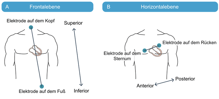 Abbildung 17. Schematische Darstellung der Ausrichtung von Extremitätenableitungen und Brustwandableitungen.