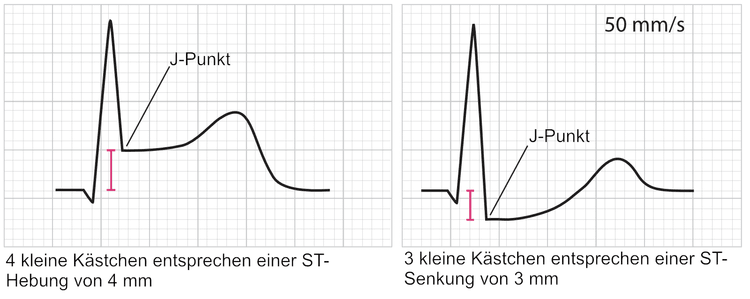 Abbildung 14. Beispiel für die Messung einer ST-Strecken-Veränderung (Hebung und Senkung).
