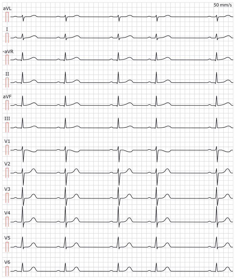 Abbildung 1. Sinusarrhythmie (Respiratorische Sinusarrhythmie).