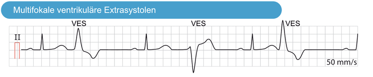 Abbildung 5. Multifokale ventrikuläre Extrasystolen. Diese ventrikulären Extrasystolen haben sowohl eine variierende Morphologie als auch ein variierendes zeitliches Auftreten im EKG. Sie stammen daher aus unterschiedlichen ektopen Fokussen.
