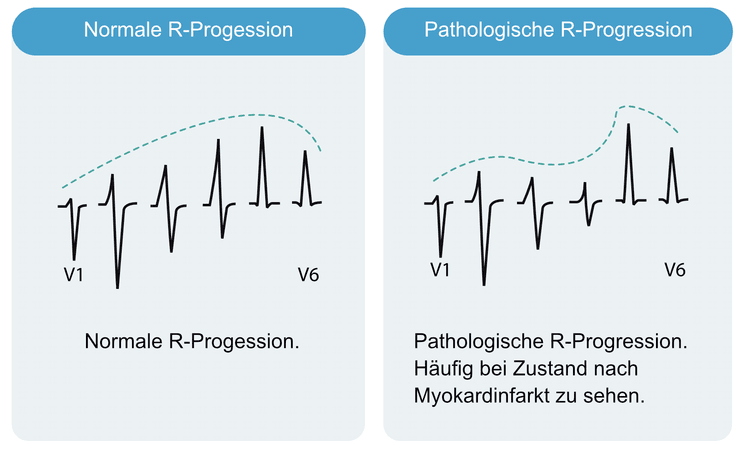 Abbildung 10. Normale und pathologische R-Progression.