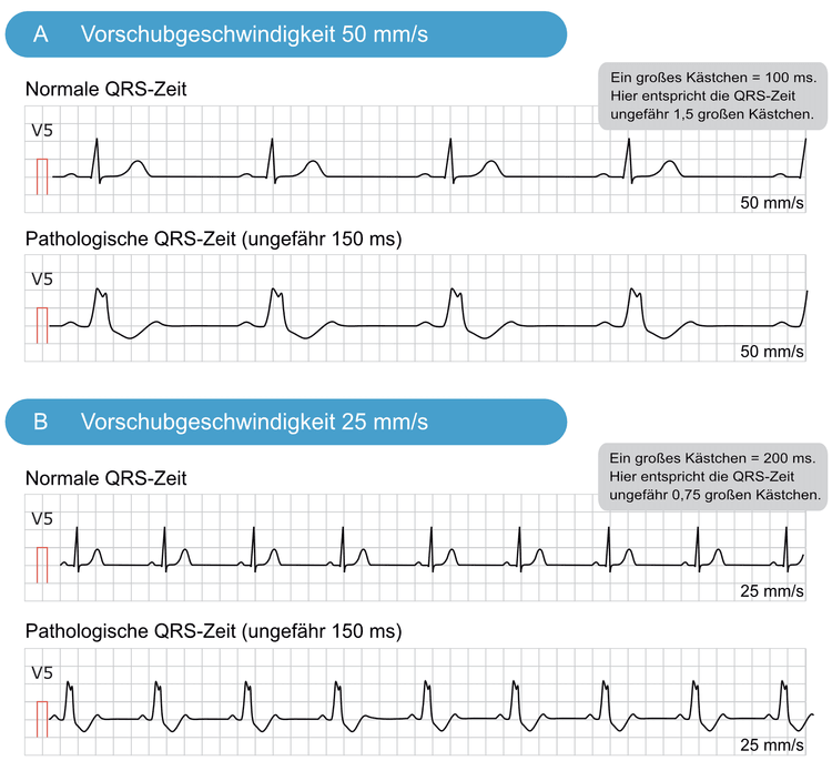Abbildung 8. Normale und pathologische QRS-Zeiten bei unterschiedlichen Papiervorschubgeschwindigkeiten.
