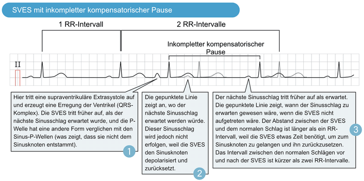Abbildung 4. Supraventrikuläre Extrasystole (SVES) mit inkompletter kompensatorischer Pause.