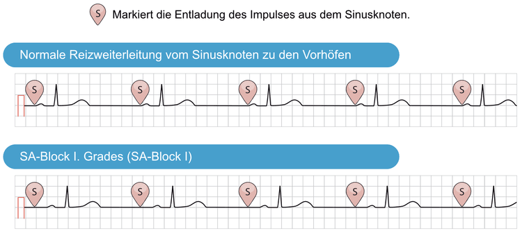 Abbildung 1. Das obere EKG zeigt eine normale Reizweiterleitung vom Sinusknoten zu den Vorhöfen. Die Vorhofdepolarisation beginnt fast unmittelbar nach der Entladung des Impulses im Sinusknoten. Das untere EKG zeigt einen SA-Block I. Grades, bei dem das Zeitintervall von der Impulsentladung zur Vorhofdepolarisation verlängert ist, was im Oberflächen-EKG nicht erkennbar ist. Wie hier zu sehen, ist der Rhythmus immer noch regelmäßig und alle Komplexe erscheinen normal.