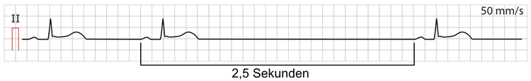 Abbildung 1. Sinusarrest.