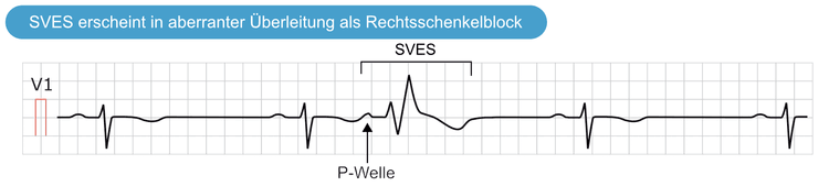 Abbildung 3. Die Supraventrikuläre Extrasystole (SVES) erscheint in aberranter Überleitung als Rechtsschenkelblock. Der Pfeil zeigt die P-Welle der supraventrikulären Extrasystole. Der folgende QRS-Komplex ist breit und hat eine abnormale Morphologie. Er erscheint wie ein Rechtsschenkelblock, was dadurch zu erklären ist, dass der rechte Tawara-Schenkel beim Eintreffen des Impulses noch refraktär ist.