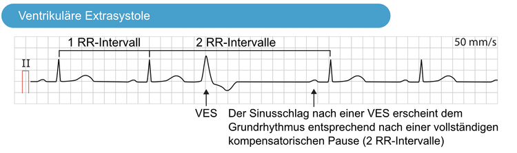 Abbildung 2. Die vollständige kompensatorische Pause nach einer ventrikulären Extrasystole.