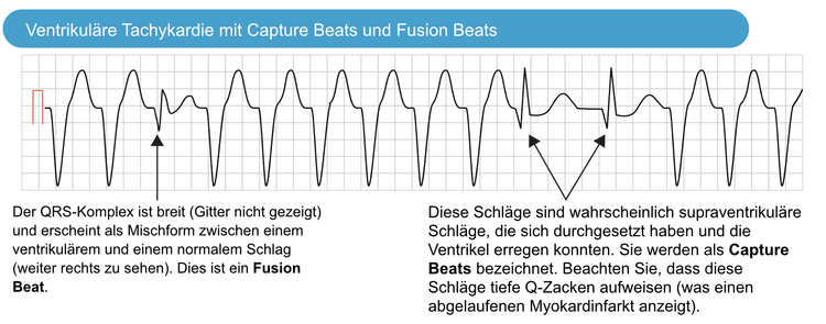 Abbildung 6. Capture Beats und Fusion Beats, die während der ventrikulären Tachykardie beobachtet wurden.
