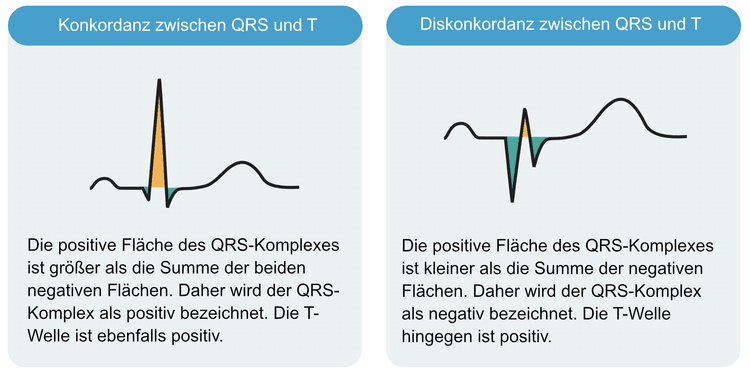 Abbildung 1. Konkordanz und Diskordanz zwischen QRS-Komplex und ST-T-Strecke.
