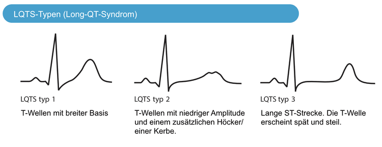 Abbildung 3. Eigenschaften von T-Wellen bei verschiedenen LQTS-Typen (Long-QT-Syndrom).