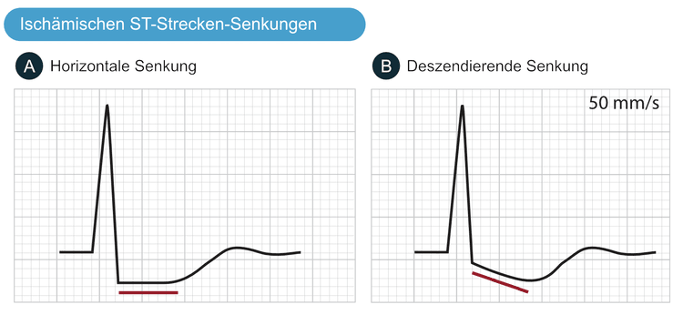 Abbildung 1. Merkmale von ischämischen ST-Strecken-Senkungen im EKG.