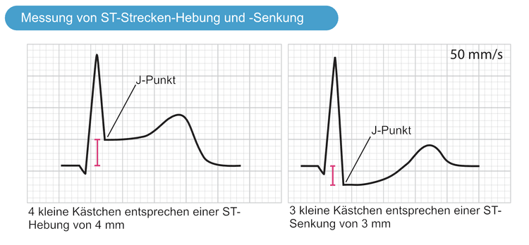 Abbildung 2. Beispiele für die Messung von ST-Strecken-Hebung und -Senkung. Eine myokardiale Ischämie ist sehr wahrscheinlich, wenn diese EKG-Veränderungen von Brustschmerzen oder anderen Symptomen begleitet werden, die auf eine Ischämie hindeuten.