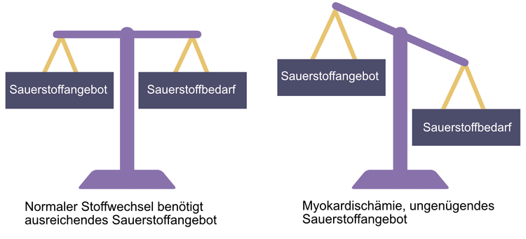 Abbildung 1. Myokardzellen benötigen eine kontinuierliche Sauerstoffversorgung, um einen normalen Stoffwechsel aufrechtzuerhalten. Wenn die Sauerstoffversorgung geringer ist als der Sauerstoffbedarf, entwickelt sich eine Ischämie. Myokardzellen können auf einen anaeroben Stoffwechsel umstellen und die Kontraktionen unterbrechen, um die Ischämie zu tolerieren. Dies ermöglicht der Zelle, eine schwere Ischämie von bis zu 30 Minuten zu überleben. Wenn der Blutfluss innerhalb von 30 Minuten nicht wiederhergestellt wird, stirbt die Zelle. Der Tod von Myokardzellen wird als Myokardinfarkt bezeichnet.