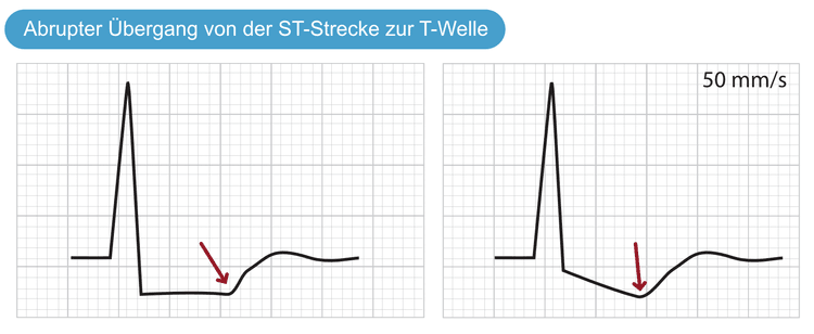 Abbildung 2. Übergang von der ST-Strecke zur T-Welle bei Ischämie.