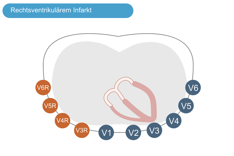 Abbildung 3. Zusätzliche Ableitungen werden bei Verdacht auf einen rechtsventrikulären Infarkt verwendet. Diese rechtsseitigen Brustwandableitungen (V3R bis V6R) werden äquivalent zu den linksseitigen Brustwandableitungen platziert, lediglich gespiegelt auf die rechte Seite.