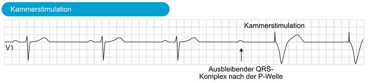 Abbildung 7. AV-Block(blockierte P-Welle), der eine Kammerstimulation auslöst.
