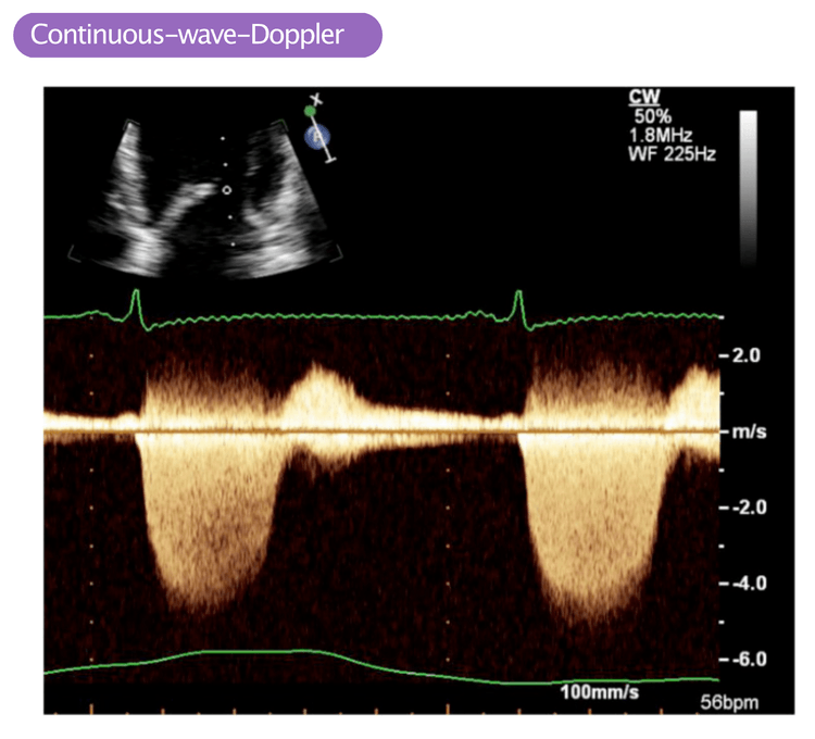 Abbildung 2. Continuous-wave-Doppler (cw-Doppler) entlang des linken Ventrikels, der Mitralklappenöffnung und des linken Vorhofs. Die vom Ultraschallkopf weggerichteten Flussgeschwindigkeiten werden unterhalb der Grundlinie angezeigt und die Geschwindigkeiten in Richtung Schallkopf werden über der Grundlinie angezeigt. Dieses Bild zeigt einen schnellen und deutlichen Fluss (fast 5 m/s), der während der Systole vom Ultraschallkopf weg gerichtet ist (die Systole beginnt auf dem Höhepunkt der R-Welle auf dem EKG). Dieses Doppler-Signal stellt eine ausgeprägte Mitralinsuffizienz dar.