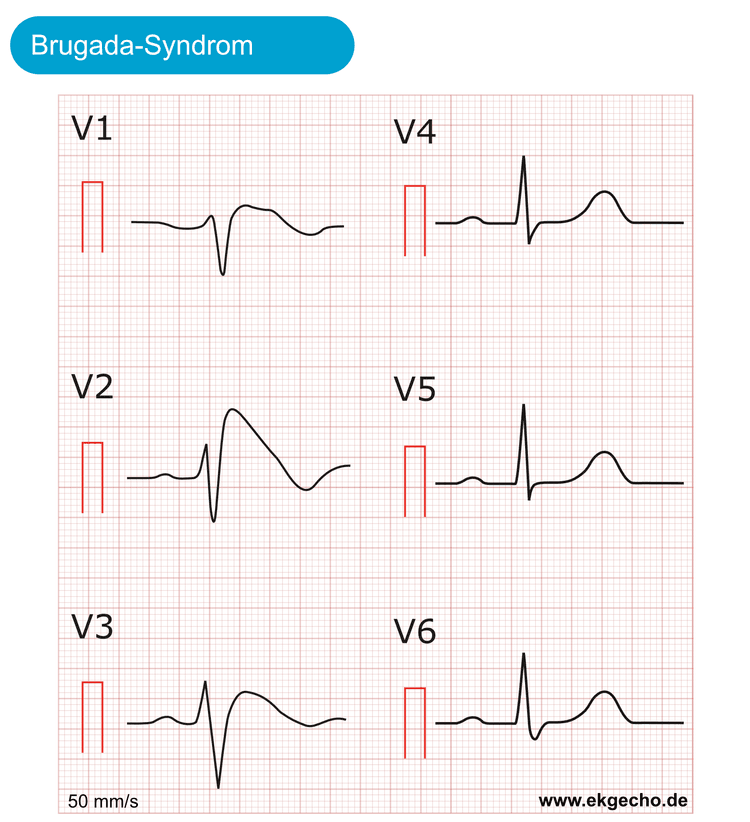Abbildung 2. Brugada-Syndrom. Beachte die gigantische J-Welle in V2 und V3. Dies kann mit einem Rechtsschenkelblock verwechselt werden. Schreibgeschwindigkeit 50 mm/s.