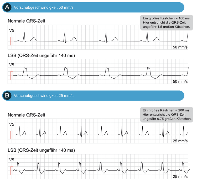 Abbildung 4. Es ist leicht, einen LSB bei 25 mm/s und 50 mm/s zu erkennen. Verwende die großen Quadrate, um die QRS-Dauer zu schätzen, wie in dieser Abbildung gezeigt. Wie in vorigen Kapiteln beschrieben, entspricht bei einer Schreibgeschwindigkeit von 25 mm/s ein großes Quadrat 200 ms und ein kleines Quadrat 40 ms. Bei 25 mm/s entsprechen 3 kleine Quadrate also 120 ms. Bei 50 mm/s entspricht ein großes Quadrat 100 ms und ein kleines Quadrat 20 ms. Bei 50 mm/s entspricht also ein großes plus ein kleines Quadrat 120 ms.