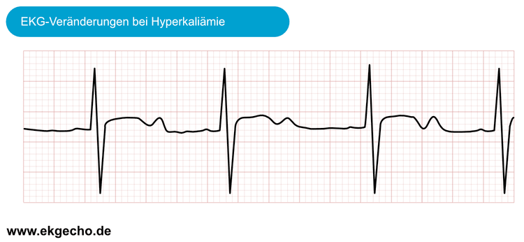 EKG-Veränderungen bei Hypokaliämie