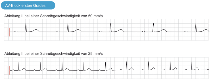Abbildung 1. EKG im AV-Block ersten Grades. Beide herkömmlichen Schreibgeschwindigkeiten werden angezeigt.