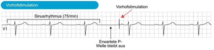 Abbildung 6. Ein fehlender oder verzögerter Sinusimpuls ruft eine Vorhofstimulation hervor.